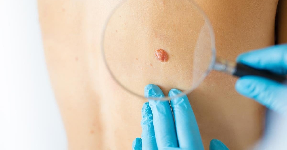 Vacuna personalizada reduce 42% el riesgo de recaída en melanoma avanzado